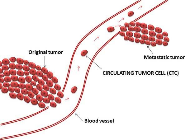 Diagram showing how circulating tumor cells (CTCs) break away from the original tumor, travel through the bloodstream, and form a metastatic tumor in another location.
