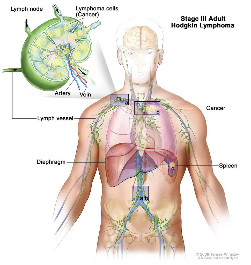 Illustration of Stage III Adult Hodgkin Lymphoma. The image shows the human body with a focus on the lymphatic system. Lymph nodes, vessels, the diaphragm, and spleen are highlighted. Cancerous lymphoma cells are present in lymph nodes above and below the diaphragm. An inset on the left provides a close-up of a lymph node, showing lymphoma cells, arteries, and veins.