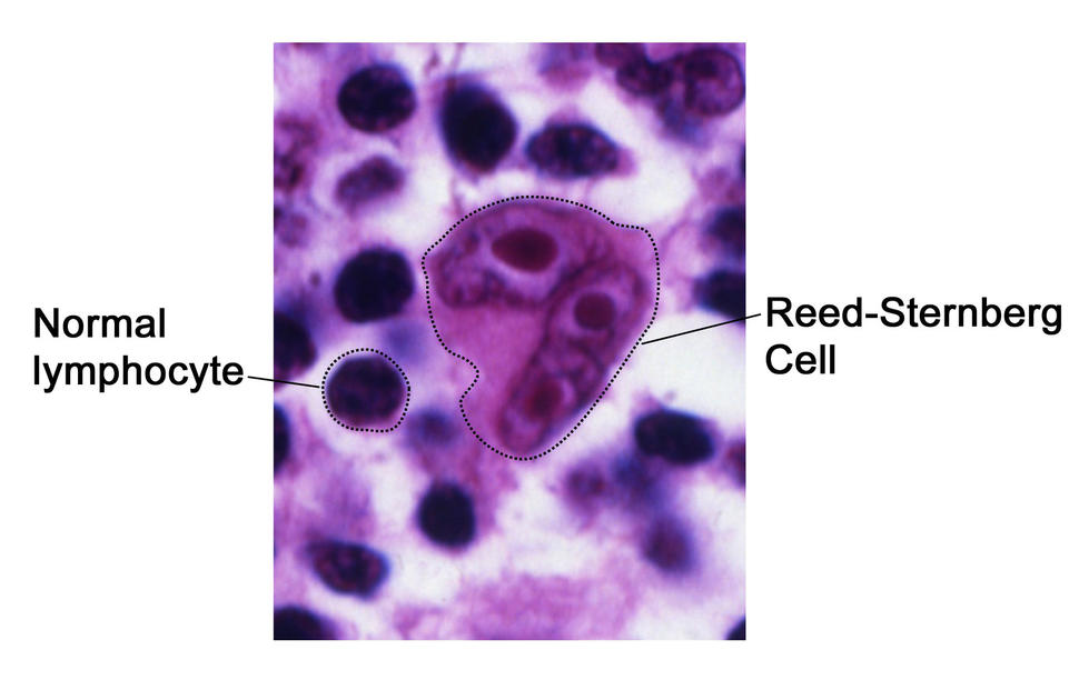 A comparison of normal lymphocytes alongside a Reed-Sternberg Cell. The lymphocyte is a dark purple circle; there are a number of these on a purple and white background. The Reed-Sternberg Cell is a medium-purple, approximately five to six times as large as the lymphocyte, and has three nuclei. 