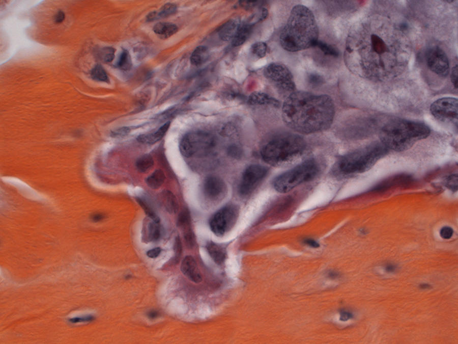 Microscopic image showing cancer cells (purple) with bone tissue (orange) and osteoclasts (red) that break down bone during metastasis, illustrating how cancer spreads to bone.