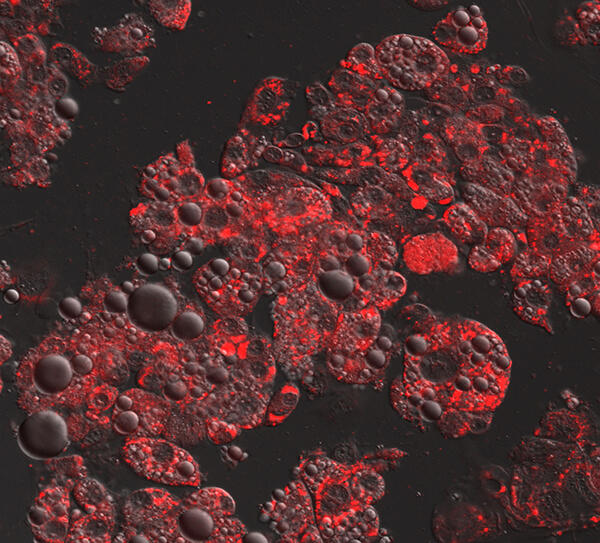Microscopic image showing fat cells absorbing the chemotherapy drug daunorubicin, potentially reducing its effectiveness.