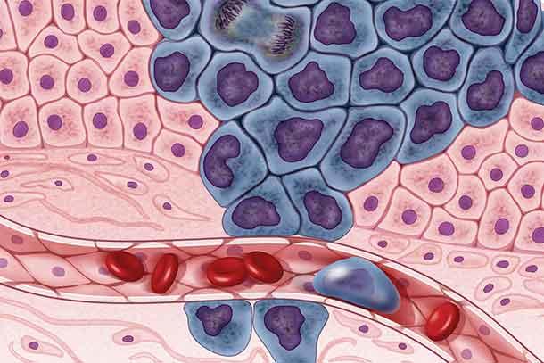 Illustration of cellular anatomy shows layers of pink cells, with an overgrowth of darker blue cells forming a mass. Below, a blood vessel contains red blood cells and a single blue cell.