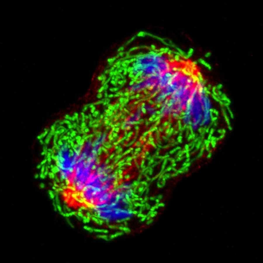 Breast cancer cell undergoing cell division.
