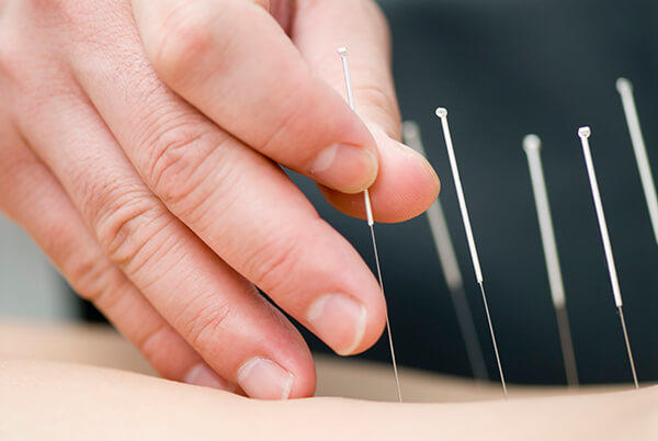Close-up of acupuncture treatment showing several thin needles inserted into a patient's body, with a practitioner's hand positioned nearby for guidance.