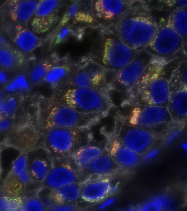 Triple-negative breast cancer cells stained to show profound molecular heterogeneity.