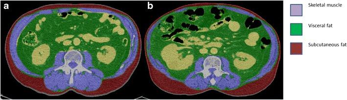 Axial CT images comparing two abdominal scans with color overlays showing skeletal muscle (purple), visceral fat (green), and subcutaneous fat (red).