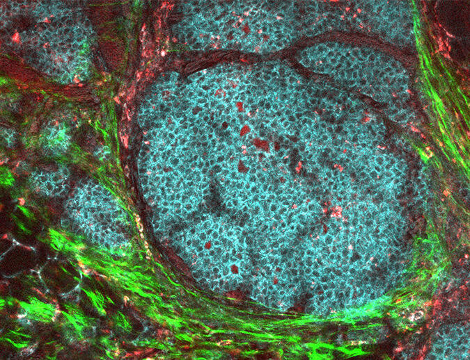 Microscopic view of a breast cancer tumor