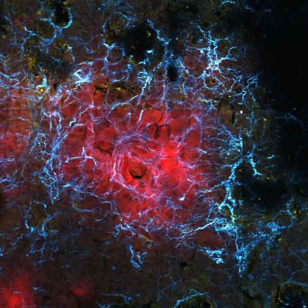 Fluorescent microscopy image showing a cancer metastasis microenvironment with red tumor cells surrounded by a network of glowing blue and yellow immune or stromal cells.