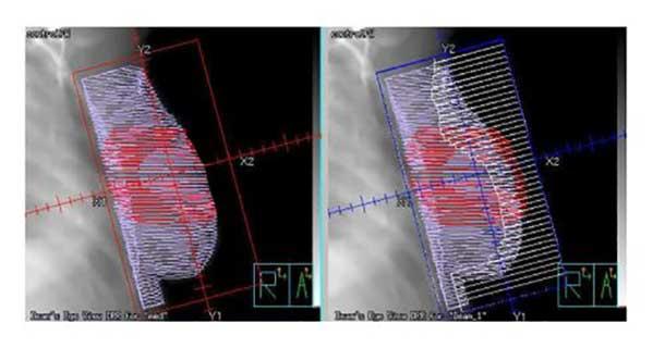 Side-by-side medical imaging scans showing breast radiation therapy planning with highlighted treatment areas and dose grids.