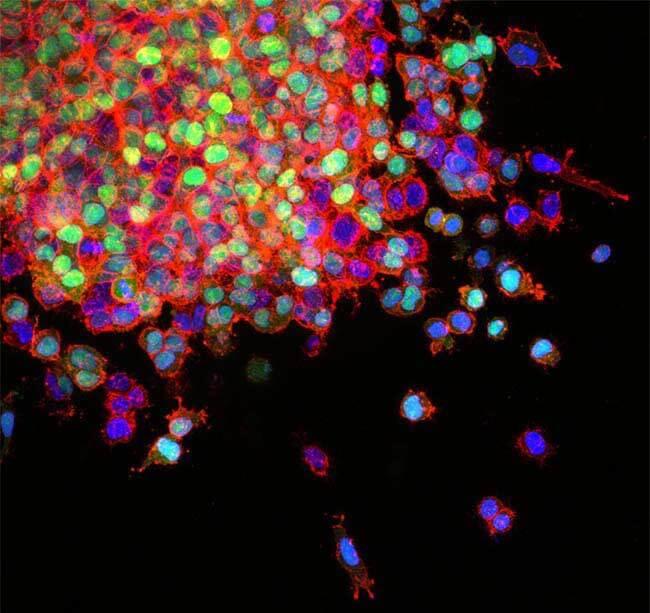 Lung cancer cells invade surrounding tissues and start to spread (metastasis).