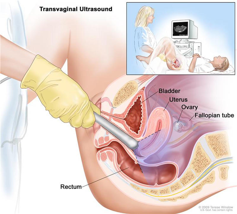 An illustrated cross-section titled “Transvaginal Ultrasound.” In the top right corner is a small illustration in which a nurse holds a transducer inside of a patient who is lying on her back, while the nurse looks at a computer screen with the ultrasound image. The larger cross section shows the transducer around surrounding anatomy, labeling the bladder, uterus, ovary, fallopian tube, and rectum. 