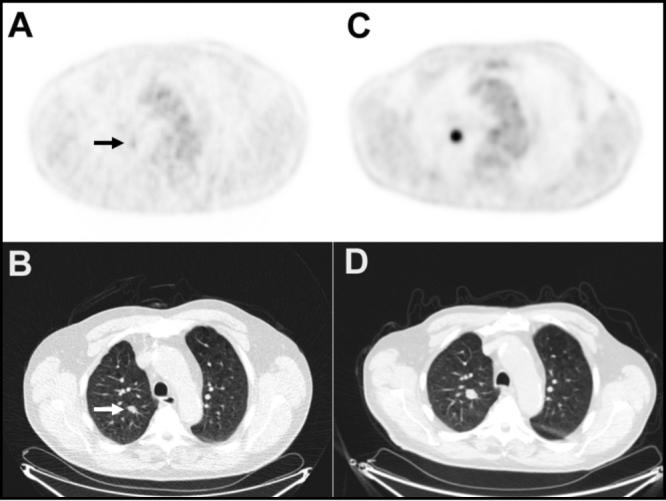 Imaging scans showing a lung nodule in panels A and B that enlarged over 11 months (panels C and D) and later confirmed as lung cancer via biopsy.