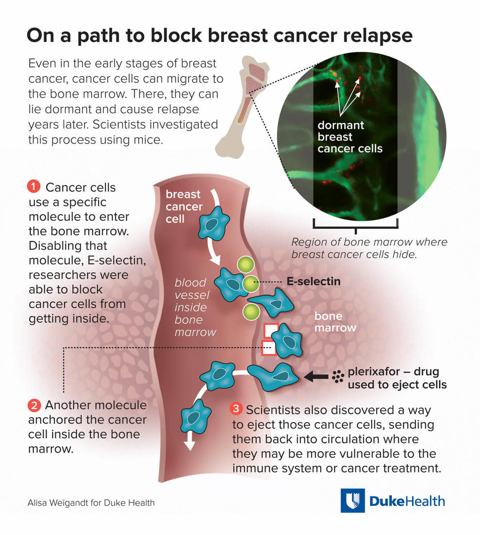 An infographic titled “On a path to block breast cancer relapse”. At top, a bone illustration emits an inset that shows dormant breast cancer cells inside of bone marrow. Below, a three-part diagram shows cancer cells entering bone marrow using the molecule E-selectin, a molecule anchoring the cancer cell, and a drug (plerixafor) ejecting the cells from the marrow.