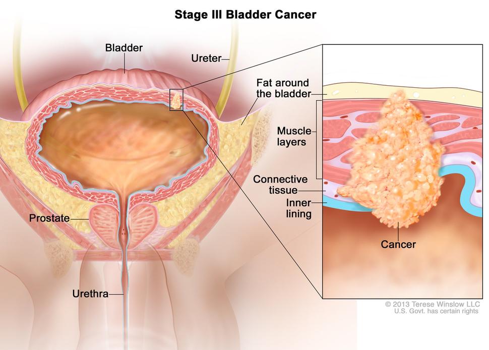 Illustration labeled “Stage III Bladder Cancer.” The main illustration labels the bladder, ureter, fat around the bladder, urethra, and prostate. A small cancer cluster inside of the muscle and fat layers of the bladder is linked to an inset illustration which labels the muscle layers, connective tissue, and inner lining of the bladder along with the actual cancer. 