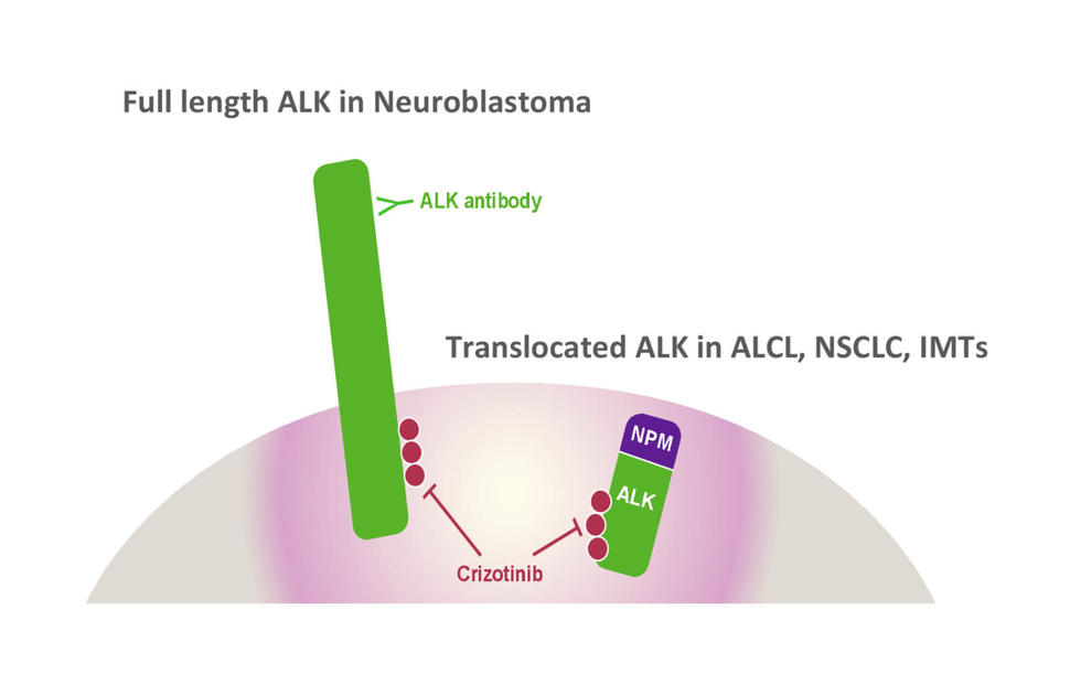Diagram showing full-length ALK in neuroblastoma targeted by an antibody, and translocated ALK in ALCL, NSCLC, and IMTs inhibited by Crizotinib.