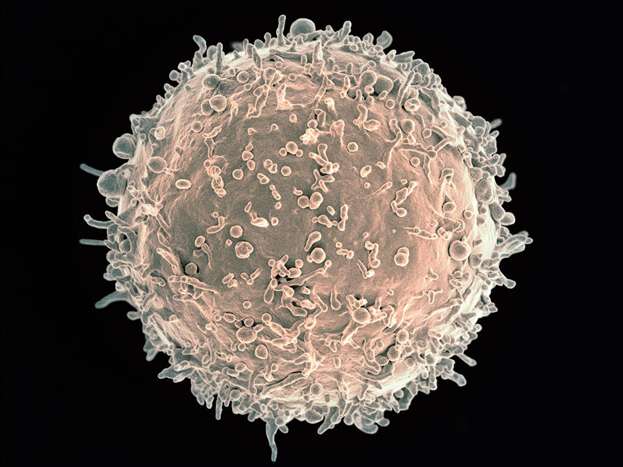 Electron microscope image of a human B cell showing its textured, spherical surface with numerous projections and small structures - the type of cell where most acute lymphoblastic leukemia develops.