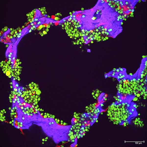 Fluorescent microscope image showing green myeloma tumor cells and red bone cells growing on a purple laboratory-made scaffold, used for research purposes.