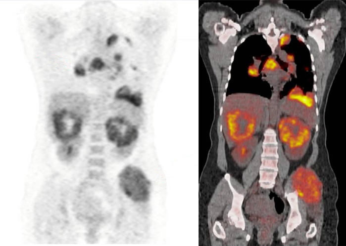 Medical imaging comparison showing a PET scan (left) and PET/CT fusion scan (right) revealing multiple metastatic lesions in a patient with renal cell carcinoma, with orange and yellow areas indicating active cancer sites.