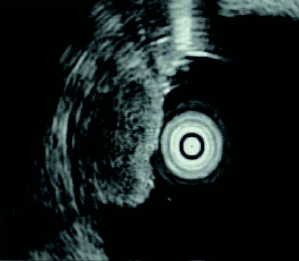 An endoscopic ultrasound of a neuroendocrine tumor (NET) in the upper gastrointestinal tract (duodenum).