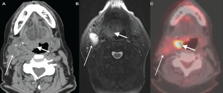 Three images of a patient with an HPV-positive oropharyngeal tumor. The first two are black and white; so is the last one, but it includes shades of red and yellow. In the middle, an arrow points at a large white shape. On the right, a different arrow points to a large yellow-white shape near the location of the white shape in the previous panel.