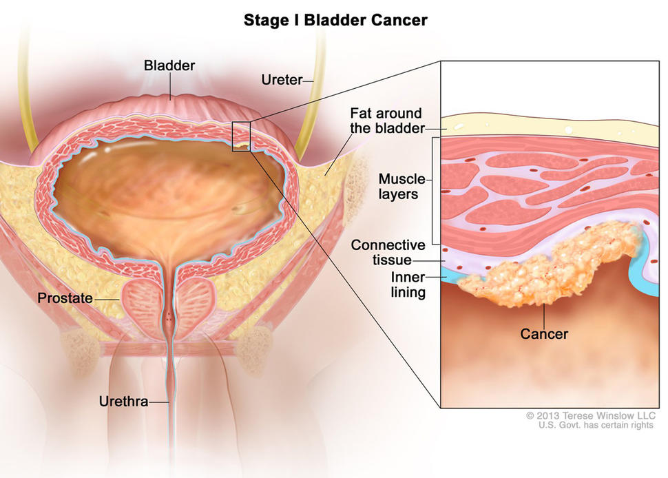 Illustration labeled “Stage I Bladder Cancer.” The main illustration labels the bladder, ureter, fat around the bladder, urethra, and prostate. A small cancer cluster inside of the muscle and fat layers of the bladder is linked to an inset illustration which labels the muscle layers, connective tissue, and inner lining of the bladder along with the actual cancer. 