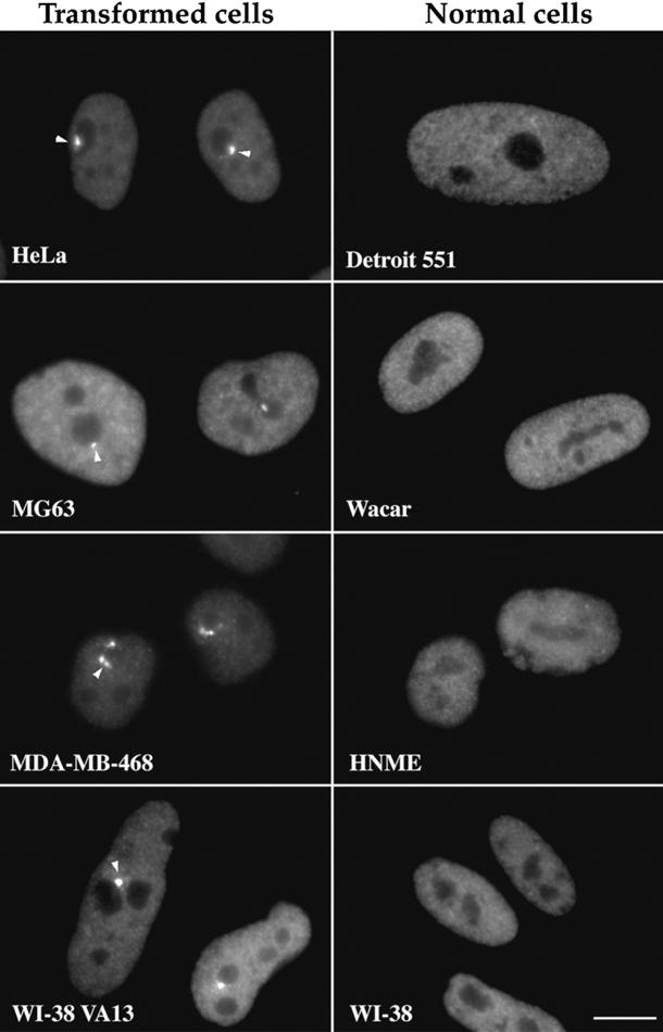 PNCs found in cancer cells (arrows) but not in normal cells.