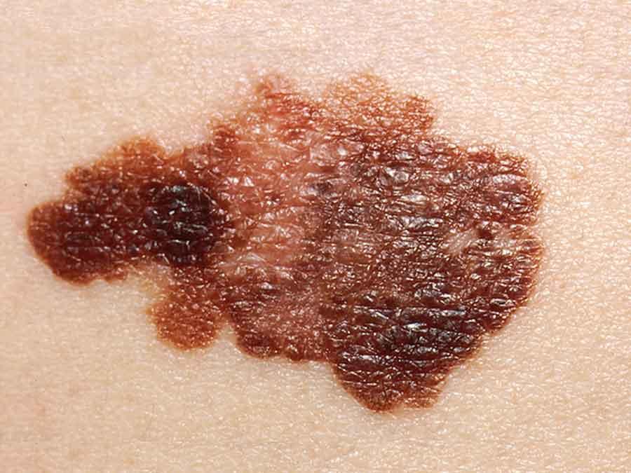 A close-up of melanoma on skin. The unaffected skin is beige or very light tan; the melanoma area is blotchy in shape, with varying levels of dark red, dark orange, and brown. 
