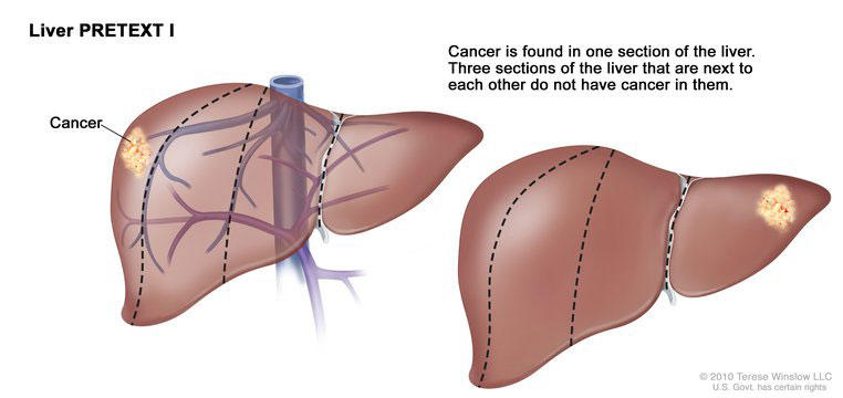Illustration titled “Liver PRETEXT I”. Two depictions of the liver are side by side. The left labels a mass of cancer on the liver and shows veins behind the liver. The right shows the cancer mass in a different position on the liver and doesn’t show any veins. Above both illustrations, text reads “Cancer is found in one section of the liver. Three sections of the liver that are next to each other do not have cancer in them.”