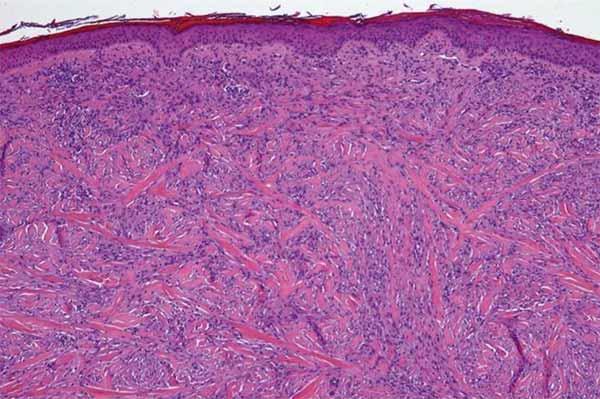 Microscopic image of desmoplastic melanoma showing spindle-shaped tumor cells embedded in dense, fibrous tissue stained in pink and purple.