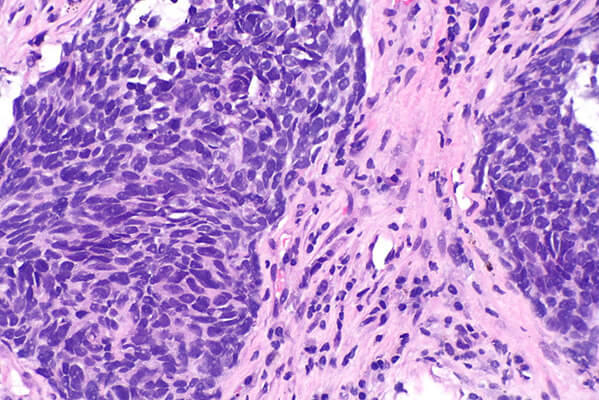 Microscopic tissue sample showing nonsquamous non-small cell lung cancer cells with purple-pink staining, displaying irregular cellular structure and abnormal growth patterns.