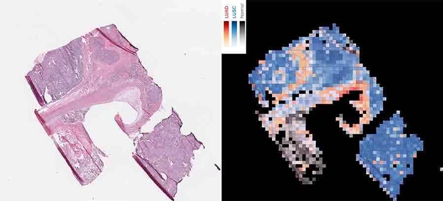 Side-by-side images of lung tissue: left shows stained slide, right shows AI-labeled cancer and normal regions.