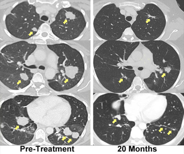 Side-by-side comparison of lung CT scans highlighting changes over time. The left column shows "Pre-Treatment" images with visible tumors indicated by yellow arrows. The right column shows scans "20 Months" post-treatment, with significant reduction in tumor size, as pointed out by the arrows.