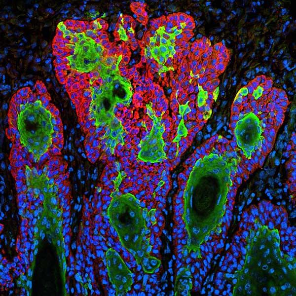 Fluorescent microscope image showing squamous cell carcinoma cells in uncontrolled growth, with green cellular structures highlighted against red and blue staining.