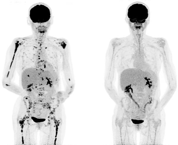 Two side-by-side PET scans of an adult body with multiple myeloma. The scans are mostly light grey; in the left scan, there are black areas spread throughout the shoulders, right arms, and throughout the lower body. On the right scan, after the BCMA-targeted CAR T cell treatment, there are approximately 80% less black areas; those that remain are mainly located in the midsection.