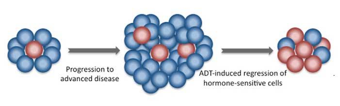 Diagram showing prostate cancer progression and regression with ADT, highlighting hormone-sensitive and resistant cells.