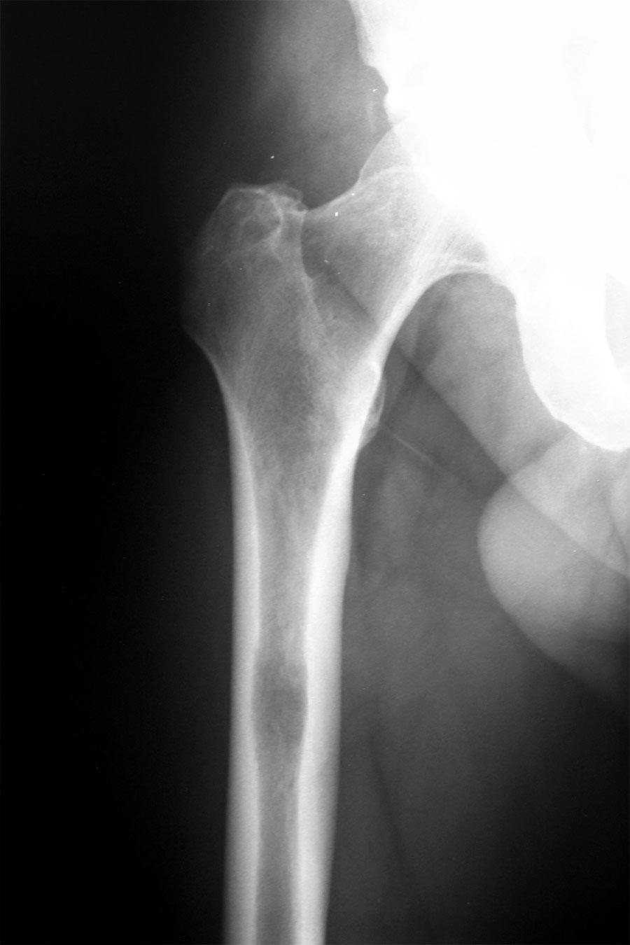 X-ray image showing the hip and upper thigh bone area, revealing a metastatic tumor that has spread to the bone tissue.
