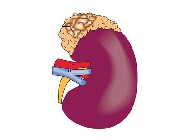 Diagram of malignant tumors on adrenal gland above kidney