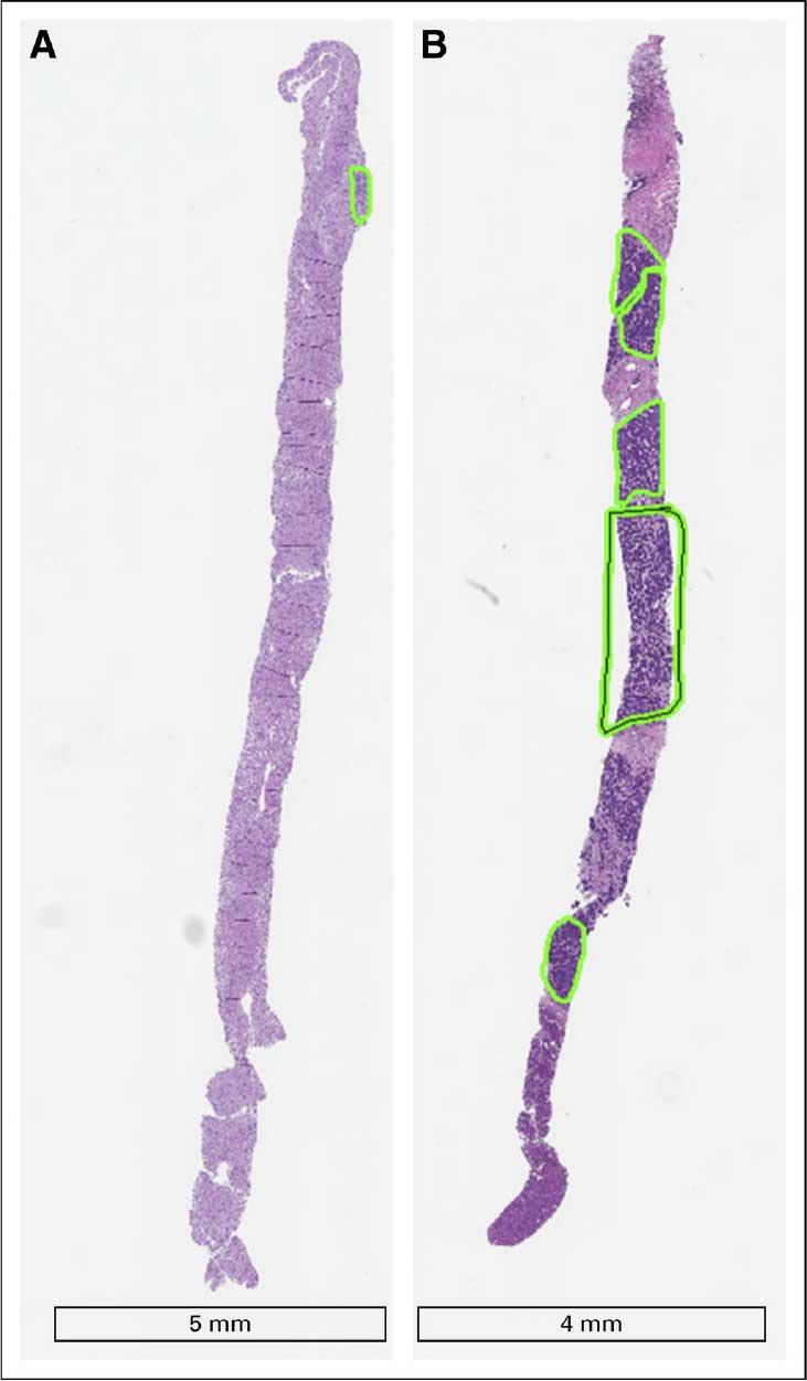 Two biopsy samples (A and B) from the same patient showing dramatically different amounts of tumor tissue, with sample A containing very little tumor tissue (small green box) while sample B contains much more tumor tissue (multiple larger green boxes)