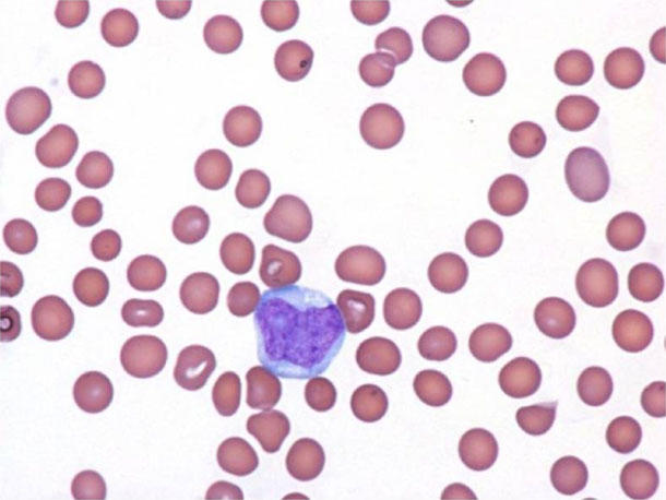 Random round shapes colored dark pink, representing blood, are scattered randomly across the image. Near a cluster of blood, a blue and purple shape representing BPDCN cells is shown.
