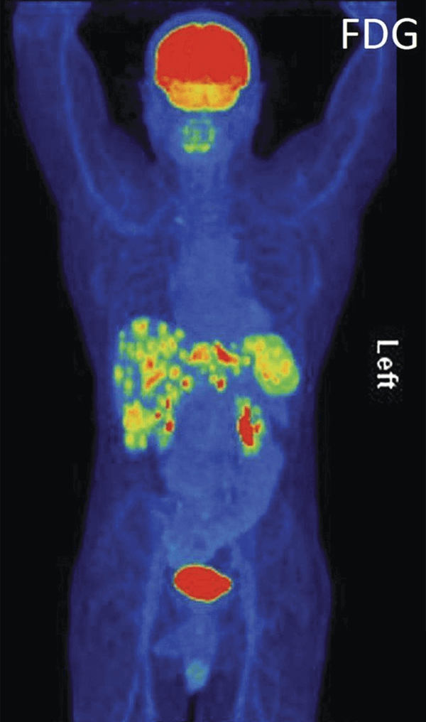 An FDG-PET scan shows a human figure from the front, highlighting areas of metabolic activity in various colors. Bright areas in red and yellow indicate higher activity, particularly in the brain, abdomen, and bladder.