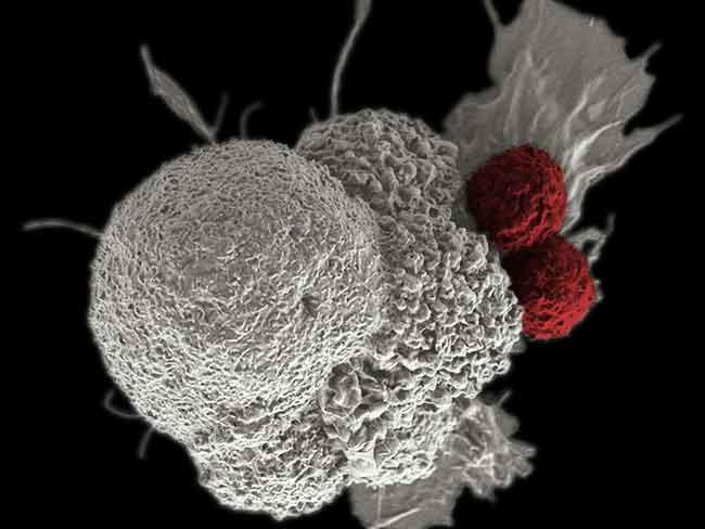 Electron microscope image showing red cytotoxic T cells attacking a white oral squamous cancer cell, demonstrating how immune checkpoint inhibitors help T cells destroy tumor cells.