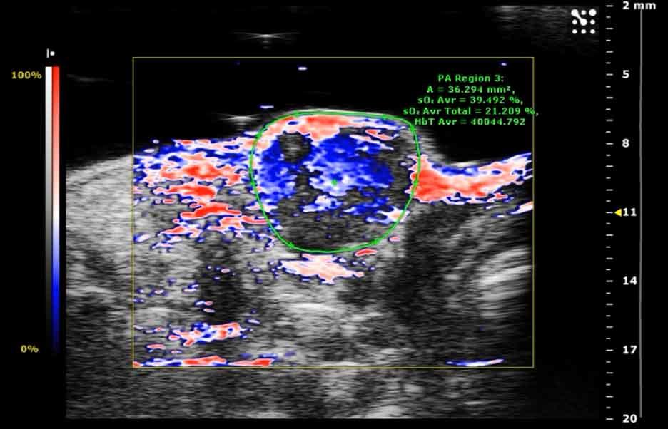 Photoacoustic ultrasound image displaying oxygen distribution (shown in red) within tumor tissue following microbubble delivery, with blue and white regions indicating other tissue characteristics and measurement data displayed on the screen.