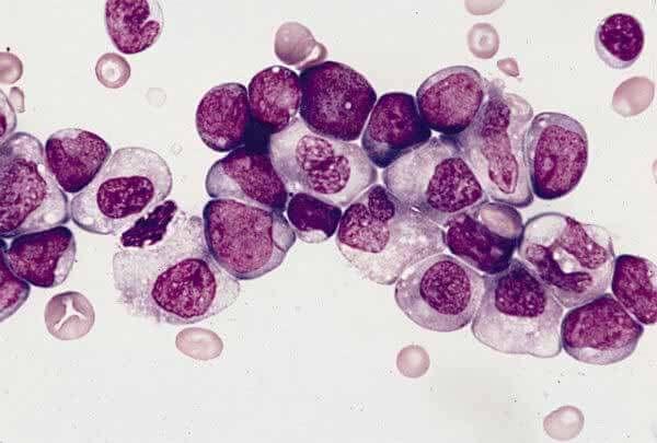Microscopic image of a bone marrow smear showing clustered purple-stained leukemia cells from a patient with acute myeloid leukemia, demonstrating the abnormal accumulation of white blood cells characteristic of this cancer.