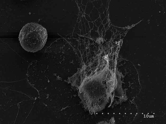 A normal neutrophil (left) next to a neutrophil that has released a trap that captures and kills pathogens.