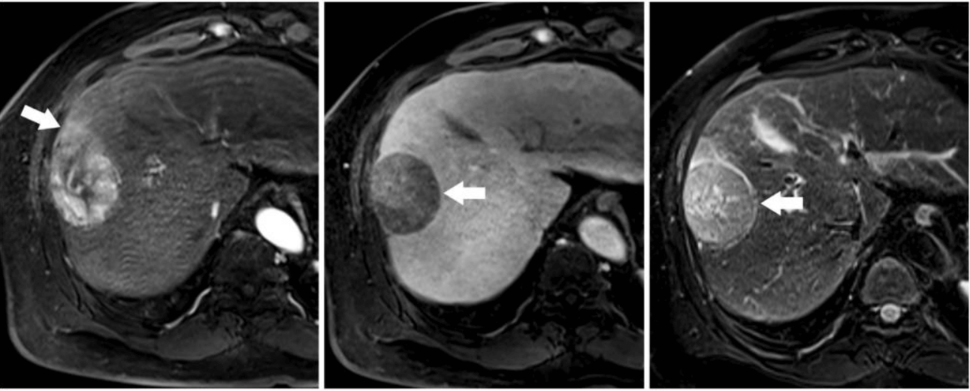 A series of three liver MRI images labeled A, B, and C showing different imaging sequences of the same liver with a mass (indicated by white arrows in each image). Each image shows the same liver lesion with different contrast and visibility depending on the MRI sequence used