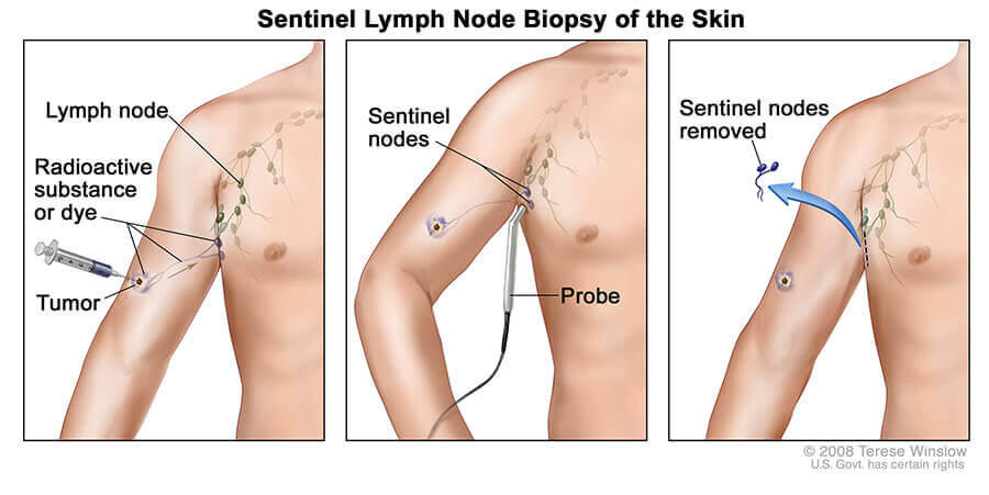 Illustration showing a three-step procedure for sentinel lymph node biopsy in skin cancer treatment. The first panel depicts an injection of a radioactive substance or dye near a tumor to identify lymph nodes. The second panel shows a probe detecting sentinel nodes. The third panel illustrates the removal of the sentinel nodes.