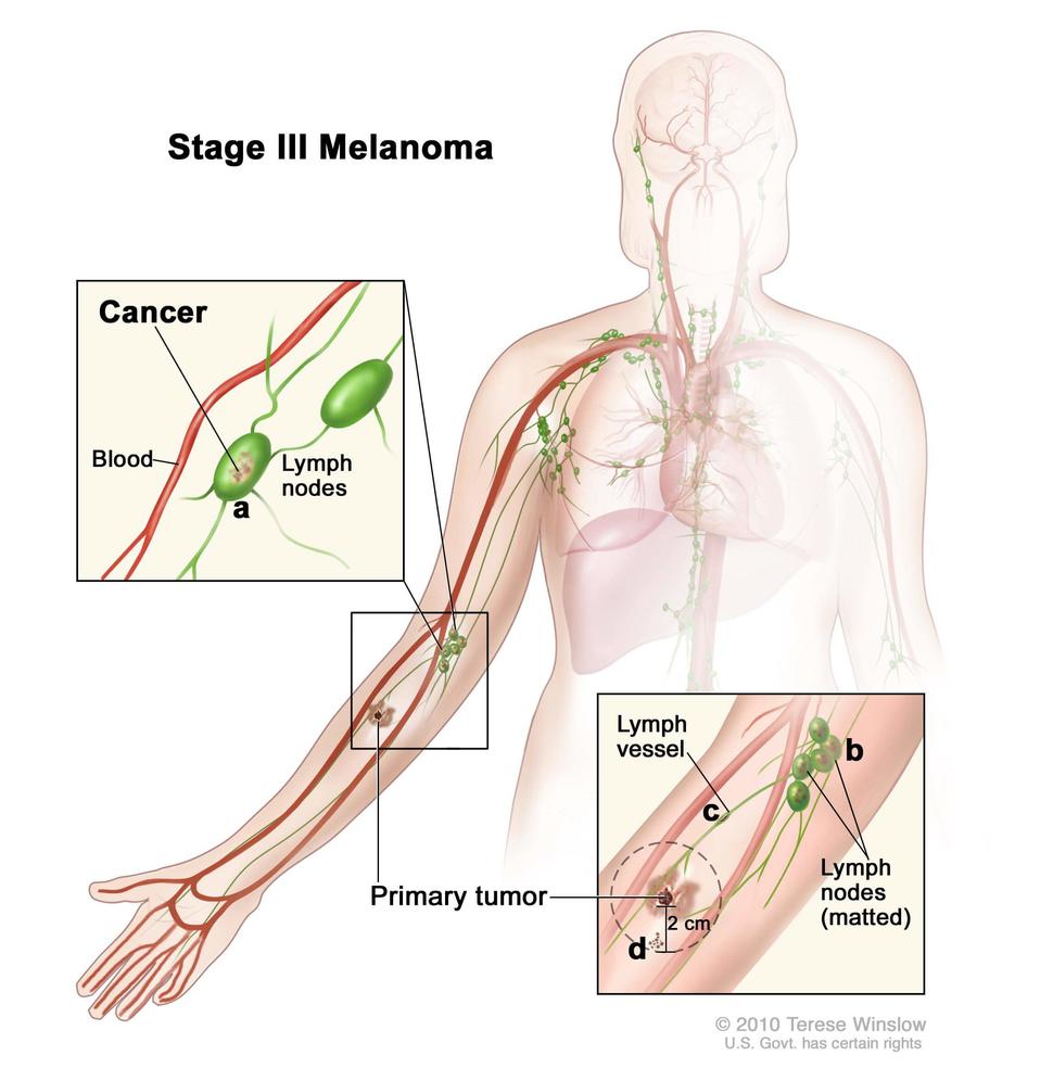 Illustration of Stage III Melanoma. The image depicts the human body with a focus on the lymphatic and circulatory systems. A primary tumor is shown on the arm, with cancer spreading to nearby lymph nodes. Insets highlight cancer involvement in lymph nodes near blood vessels as well as lymph vessel proximity to the primary tumor. Labeled features include lymph vessels, matted lymph nodes, and a primary tumor measuring 2 cm.