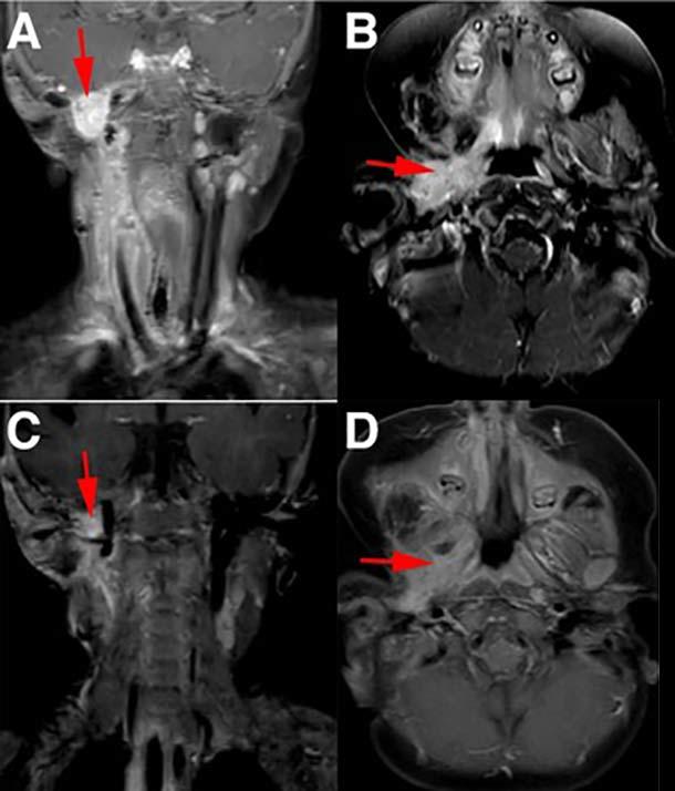 Four MRI images showing before (A, B) and after (C, D) treatment of infantile fibrosarcoma with larotrectinib, demonstrating significant tumor reduction in the neck and oral cavity areas marked with red arrows.