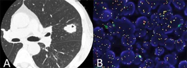 A chest CT scan of a lung tumor (panel A) and a FISH test from a sample of the tumor (panel B) showing an ALK gene rearrangement (red and green spots).