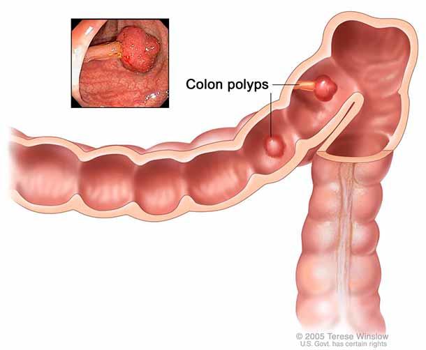 Close-up illustration of a section of the colon with two polyps, which are labeled. A small inset photograph in the top left shows a photo of a colon polyp.